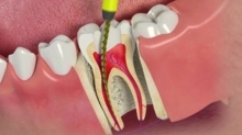 Opt for Bleeding Gum Treatment without Delay to Retain Your Health