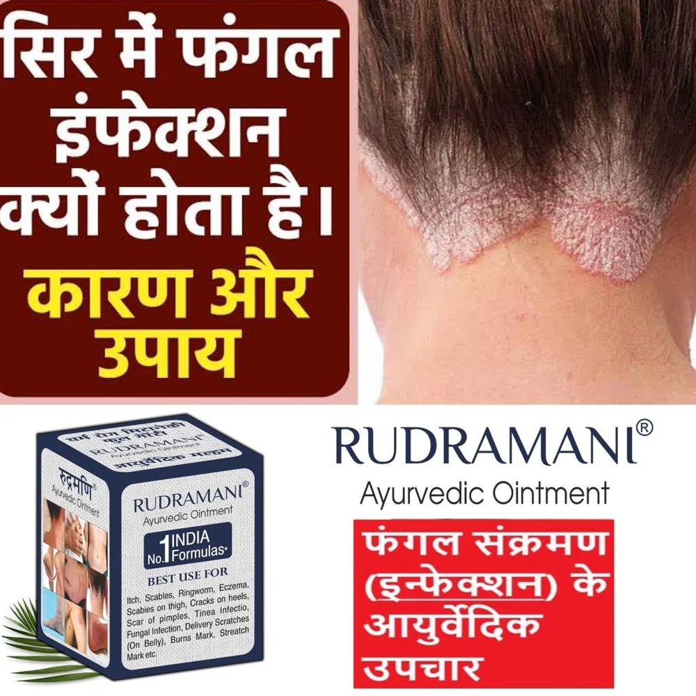 Ayurvedic Anti Fungal Rudramani Ointment,Cream, Bottle